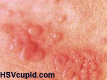 Sex with Herpes The Real Talk on Everything You Need to Know